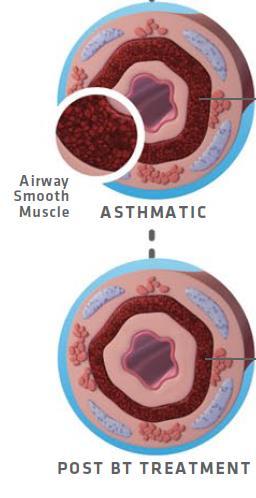 Bronchial Thermoplasty Reduces ASM Reduce Airway Smooth Muscle (ASM) Reduce