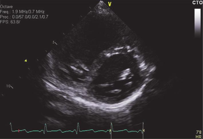 Case Reports in Pediatrics 3 RV RV LV LV (a) (b) Figure 1: (a) ECHO at diagnosis showing a short access view of the