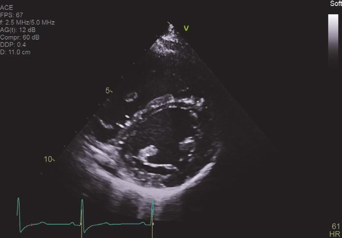 ventricle. (b) At follow-up (after treatment); significant improvement in the interventricular septal morphology.