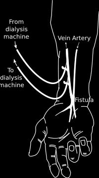 Preferred access method Surgeon joins artery and vein together in anastomosis Fistula can be located on hand, radial, or brachial area By bypassing capillaries, blood flows rapidly through the