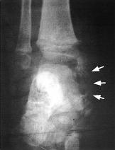 216 Trevor s disease 1a 1b 1c Figure 1. Serial lateral radiographs of right an