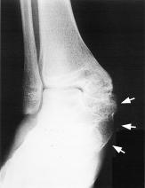 CASE REPORT A 21-year-old woman was admitted to our hospital because of right ankle bony mass for more than 10 years.