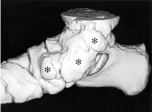 Trevor s disease 217 2b 2a Figure 2. Craniocaudal a. and lateral b.