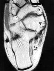 with cartilage caps over the medial malleolus and talus medial site was found during the operation.