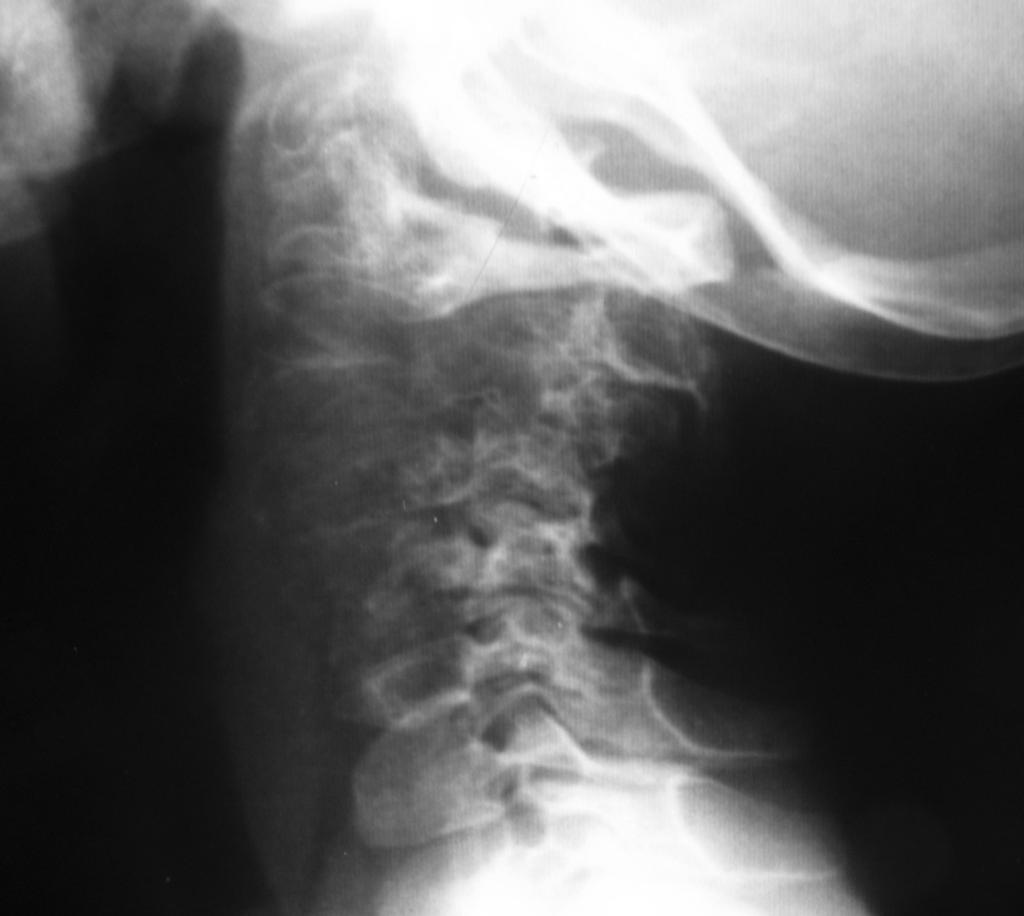 Fig. 10: Lytic tumor of 4 vertebral bodies,