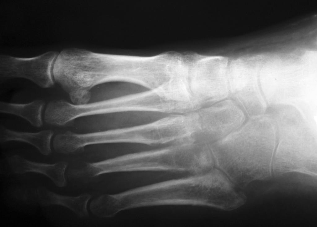 Fig. 15: Involvement of the tibia by muultiple lytic lesions.
