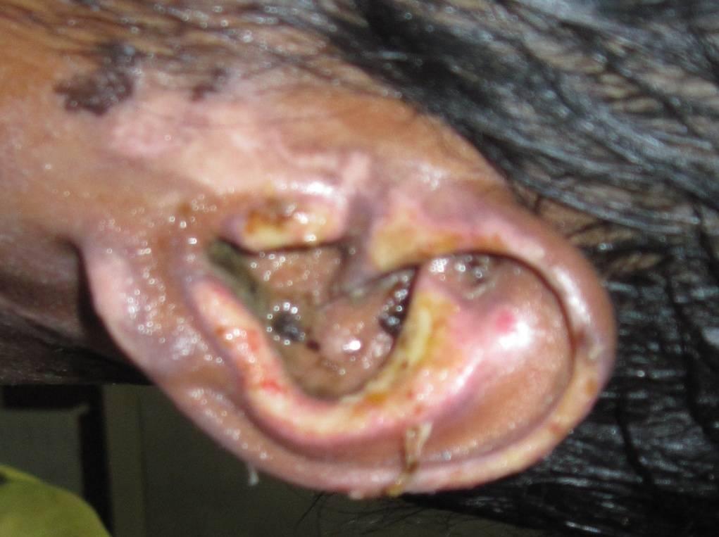 Table 3: Degrees of Burns Among Auricle Figure 2: Deformed Ear Following Chondritis Degree of burns No Percentage Second degree sup 20 27 Second degree deep 46 62.2 Deep 8 10.