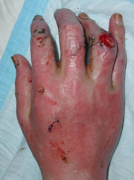 Hand Burns: Dorsal Dorsal skin: thin, mobile, minimal subcutaneous tissue