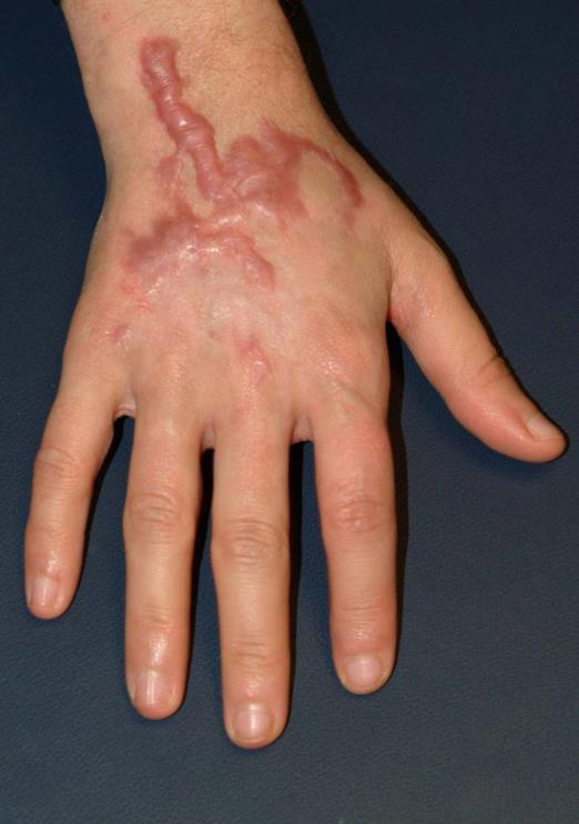 Hypertrophic scarring Painful, pruritic, exacerbate contractures Can occur in wounds that take longer