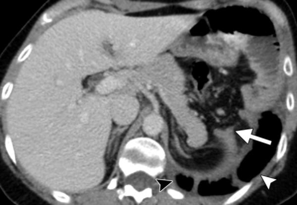 486 March-April 2012 radiographics.rsna.org Figure 9. Left-sided BDR in a 42-year-old man after a motor vehicle accident.