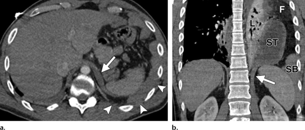 488 March-April 2012 radiographics.rsna.org Figure 12. Left-sided BDR in a 36-year-old man after a motor vehicle accident.