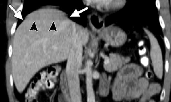 Abdominal fat and small bowel (arrowheads) are seen posterior and lateral to the spleen and the remaining part of the diaphragm (dependent viscera sign, abdominal content peripheral to the diaphragm