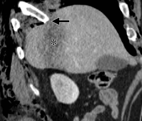 (b) Coronal reformatted CT image clearly depicts a fold in the intact diaphragm (arrow) at the level at which a was obtained (horizontal white line).