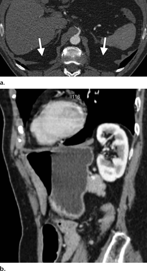 494 March-April 2012 radiographics.rsna.org fractured rib sign is low; no specificity statistics have been reported (13).