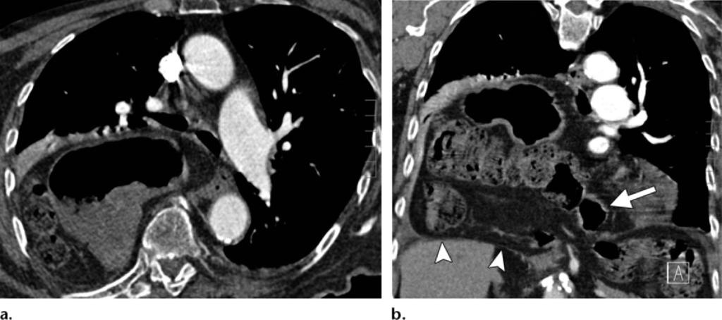 RG Volume 32 Number 2 Desir and Ghaye 495 Figure 22. Large hiatal hernia in an 86-year-old man.