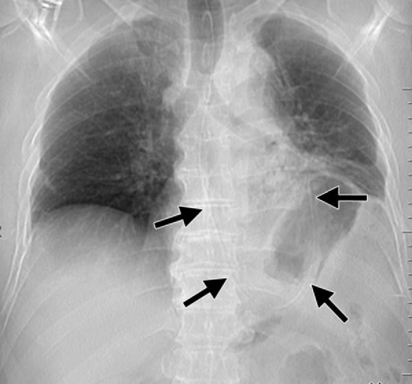496 March-April 2012 radiographics.rsna.org as pneumothorax, pulmonary contusion, and multiple fractures of the ribs, spine, or both (2,3,5,6,23,51,69).