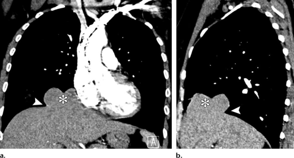 480 March-April 2012 radiographics.rsna.org Figure 2. Right-sided BDR discovered incidentally in a 43-year-old woman 10 years after severe thoracoabdominal trauma due to a motor vehicle accident.
