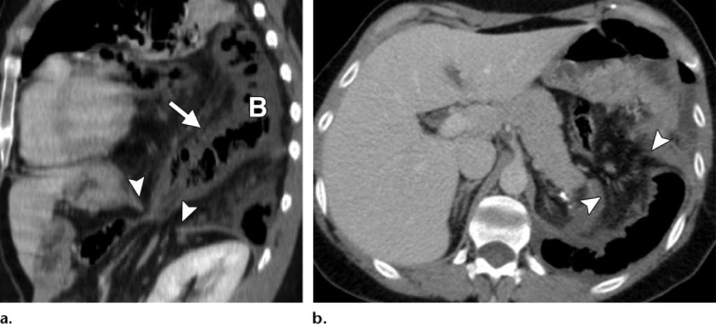 RG Volume 32 Number 2 Desir and Ghaye 481 Figure 3. Bowel strangulation in a 19-year-old woman with severe abdominal pain and sepsis 7 years after severe blunt trauma.