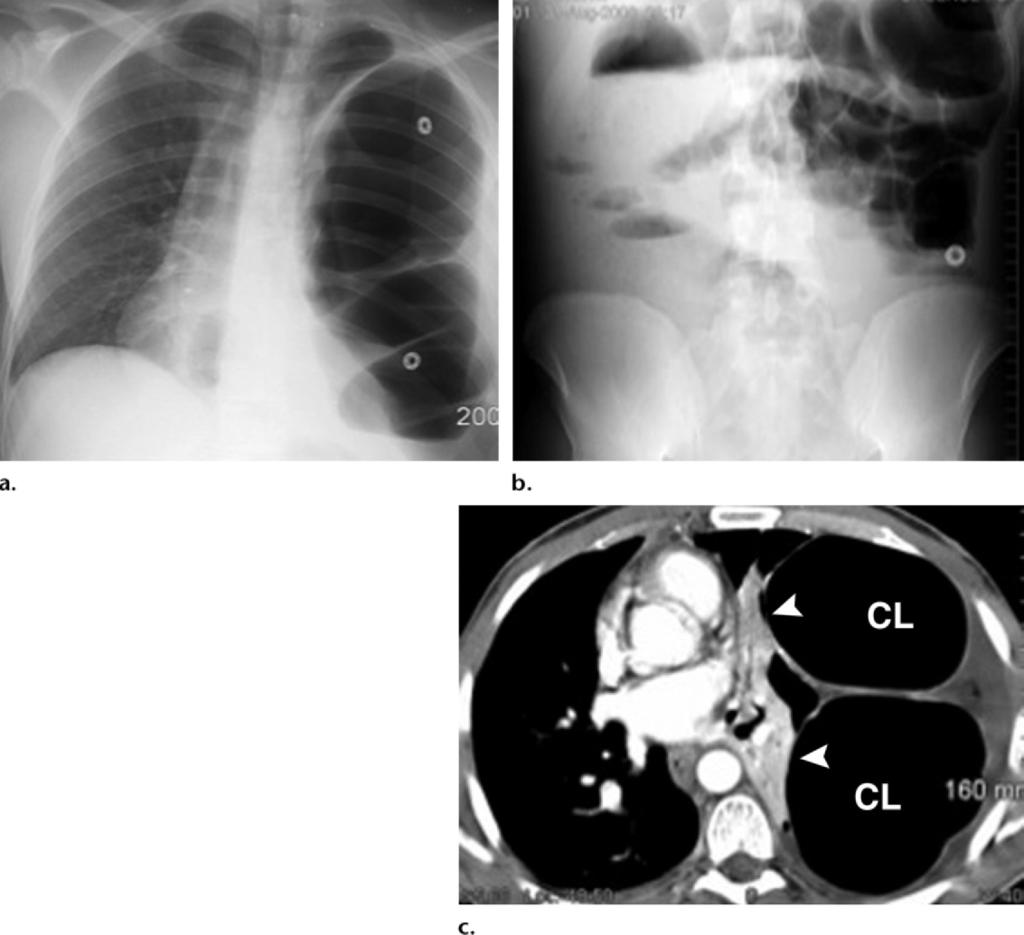 482 March-April 2012 radiographics.rsna.org Figure 5. Left-sided BDR complicated by bowel obstruction in a 30-year-old man 1 year after a traffic accident.