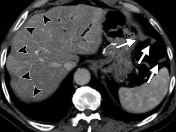 (b) Axial CT image obtained at a higher level in the same patient shows poor delineation of the diaphragm in the absence of an interposed fat layer between it and both the liver (arrows) and spleen