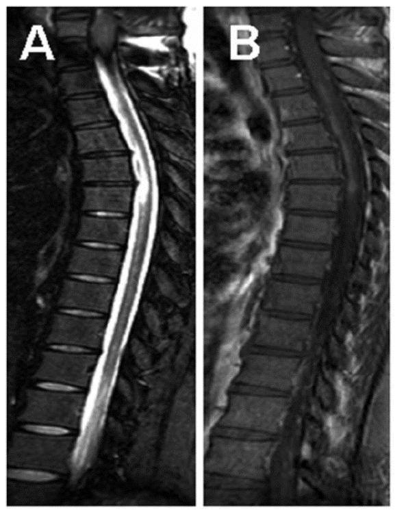 mass lesion Spinal cord lesion