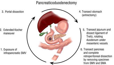 The Whipple Operation Illustrations Fig. 1. Illustration of the sixstep pancreaticoduodenectomy (Whipple operation) as described in a number of recent text books by Dr. Evans.