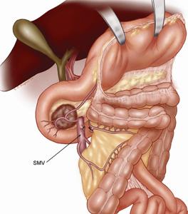 The lesser sac is entered, and the hepatic flexure of the colon is taken down. The inferior body of the pancreas is identified at the level of the proximal body of the gland.