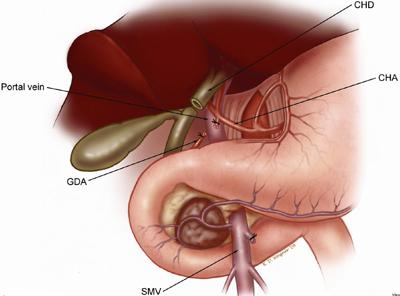 One can then mobilize the duodenum and pancreatic head off of the IVC in a cephalad direction thereby removing all soft tissue anterior to the IVC.