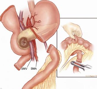 Sometimes the entire stomach is preserved; when this is done, the operation is called a pylorus preserving Whipple (or pancreaticoduodenectomy). Fig. 6. Illustration of step 5.