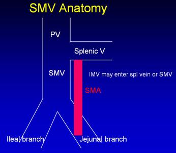 Fig. 9. Illustration of the important surgical anatomy of the superior mesenteric vein (SMV). The SMV usually bifurcates into two main branches, one to the ileum and one to the jejunum.