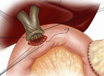 monofilament suture. Fig. 15. Illustration of hepaticojejunostomy.