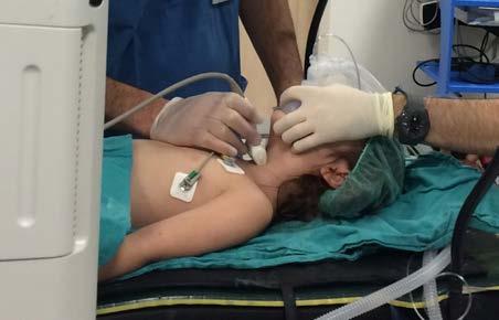 Use of ultrasonography as a noninvasive decisive tool to determine the accurate endotracheal tube size in anesthetized children / 173 PATIENTS AND METHODS This prospective study was approved by the