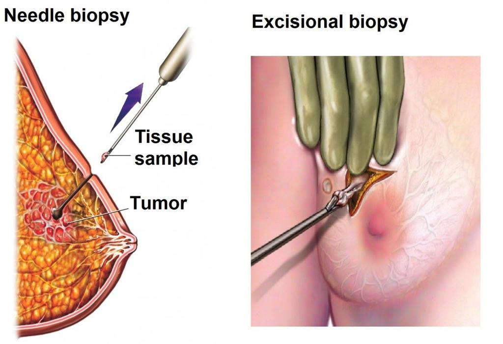 Biopsy Techniques Needle Biopsy Fewer trips to the operating room Can sample multiple abnormal areas