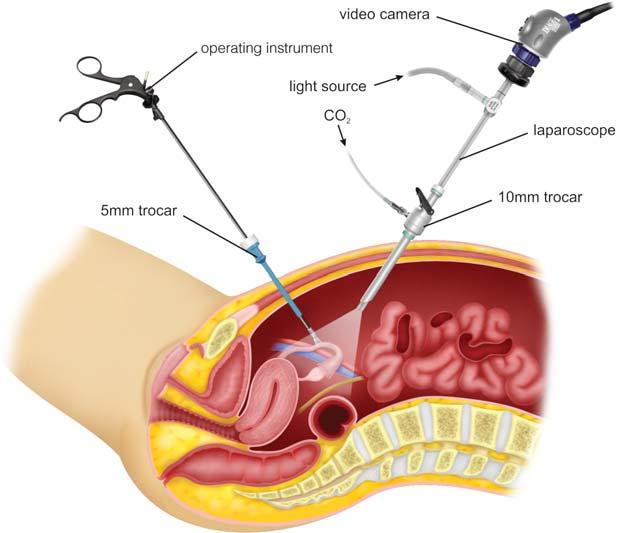 Laparoscopy A laparoscope is a thin telescope that is inserted into the abdomen through a tiny incision (cut).