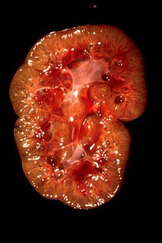 kidneys with DPD) Adults: Autosomal Dominant