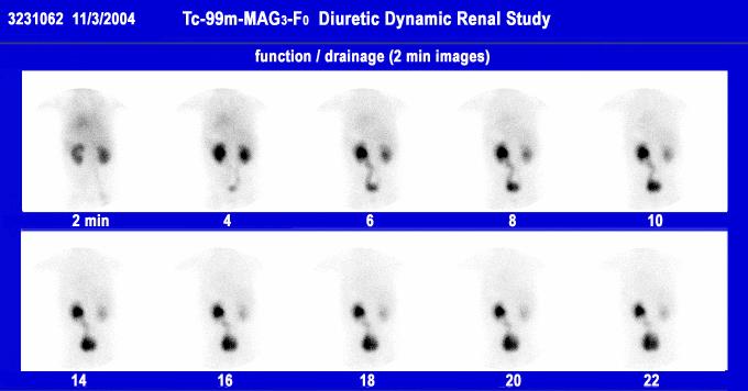 Congenital Pelviectasis and Mega-ureter 11/3/2004 First Study Case