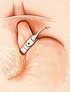 (4) LAPAROSCOPIC ADJUSTABLE GASTRIC BANDING (LAP BAND): The LAP BAND: I understand that the procedure that Dr.
