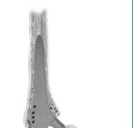 Stem Implantation The stem is inserted and impacted using the impactor in contact with the proximal tip of the prosthesis (Fig. 10).