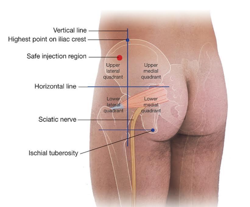 Site of hip pain Posterior Back problems, SIJ pain Piriformis syndrome Avulsion