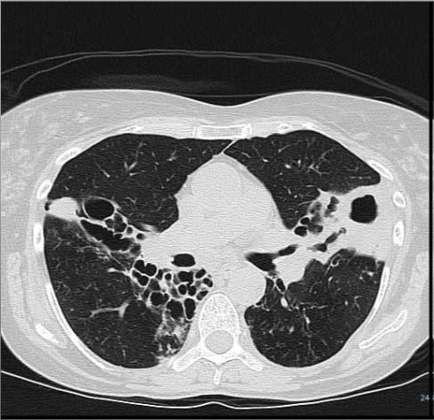 What is the most likely cause of bronchiectasis