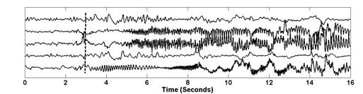 However, detecting seizures is challenging due to significant intracranial EEG signal variability across patients.