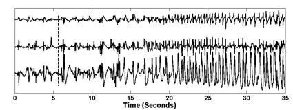 seizure looks similar whenever it reoccurs. This is demonstrated in Figure 3 which shows a second seizure from patient A. Figure 5: Linear and Nonlinear SVM decision boundaries.