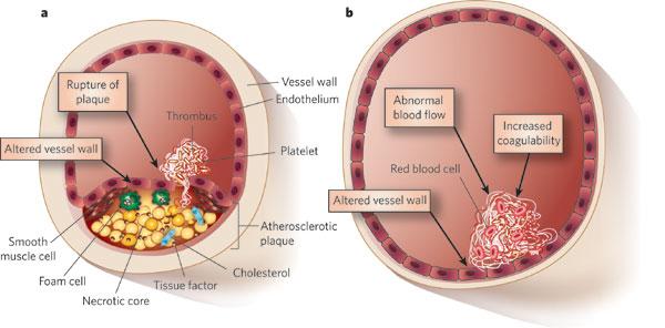 Arterial and Venous Thrombosis