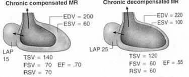 Chronic MR - Pathophysiology When systolic function worsens (decreased LVEF) -> further increase in LVEDV and LA pressure -> pulmonary congestion.