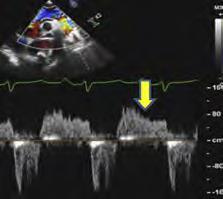 Flow reversal in the proximal descending aorta Depends on compliance of the aorta; less reliable in older patients Brief velocity