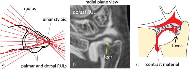 Note that TFCC insertions to the fovea and the ulnar styloid are clearly visualized. R: radius, U: ulna. history of a distal radius fracture.
