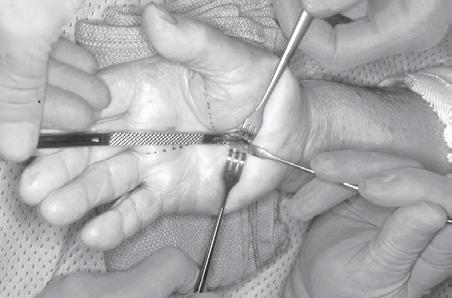 The surgeon who performs any procedure is responsible for determining and using the appropriate techniques for using the device in each patient.