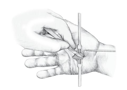 It should stop about 2 cm distal to the wrist flexion crease (slightly ulnar to the thenar crease). Longitudinal Line Hook of Hamate 1.
