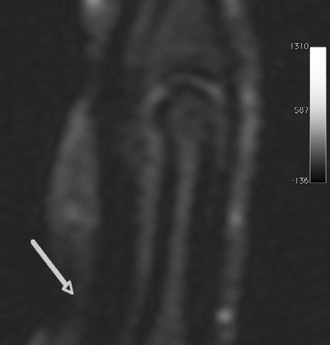 Figure 5 MRI of the finger with the C1 pulley rupture in a transversal plane. The arrow points to the observed scar tissue.