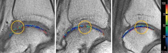 Imaging of Cartilage Repair T2-Mapping after Microfracturing 8 month 18 month 23 month T2-index